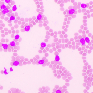 Bild akuter lymphatischer Leukämie-Zellen im Blut, mikroskopische Aufnahme